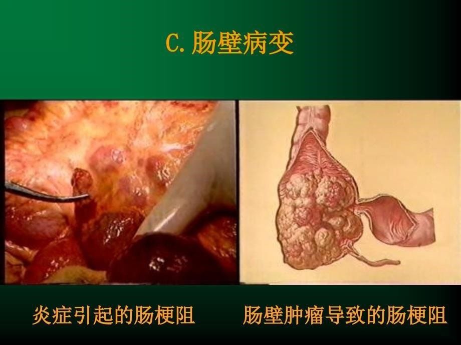 肠梗阻ppt课件-医学资料_第5页