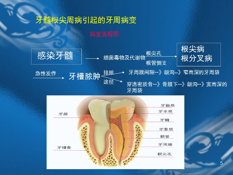 牙周炎的伴发病变PPT_第5页