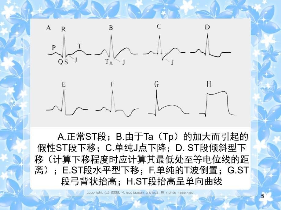 心电图(常见)PPT_第5页