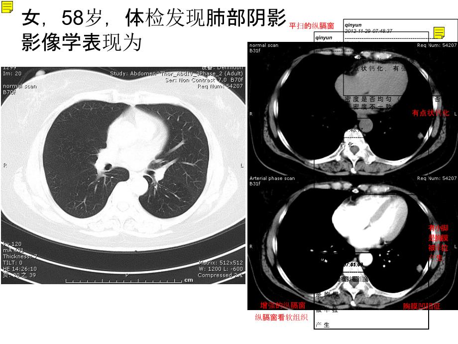 【影像学学习】_呼吸系统肿瘤及纵膈病变-北京协和医院学习_第2页