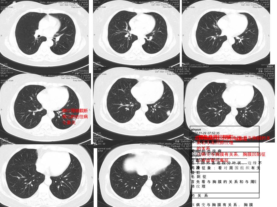 【影像学学习】_呼吸系统肿瘤及纵膈病变-北京协和医院学习_第3页