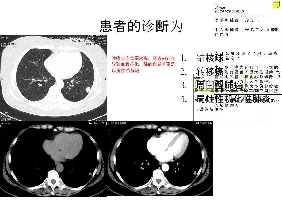 【影像学学习】_呼吸系统肿瘤及纵膈病变-北京协和医院学习_第4页