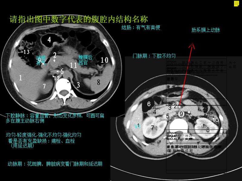 【影像学】_讨论课3. 消化系统实质脏器问题-北京协和医院学习_第4页