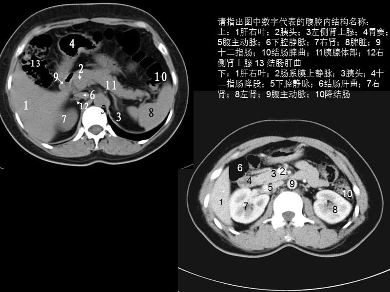 【影像学】_讨论课3. 消化系统实质脏器问题-北京协和医院学习_第5页