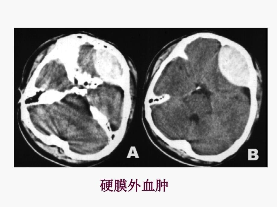 中枢神经系统影像学-颅脑外伤_第5页