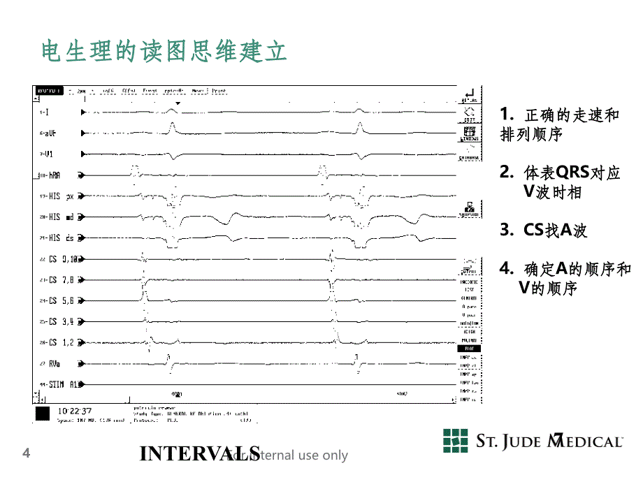 阵发性室上性心动过速最新版本_第4页