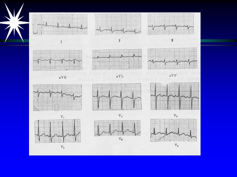 急救培训(心电图)幻灯片课件_第4页