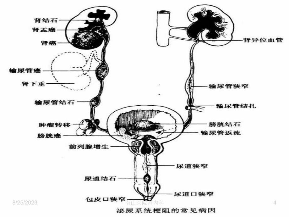 尿路感染病人的护理幻灯片课件_第4页