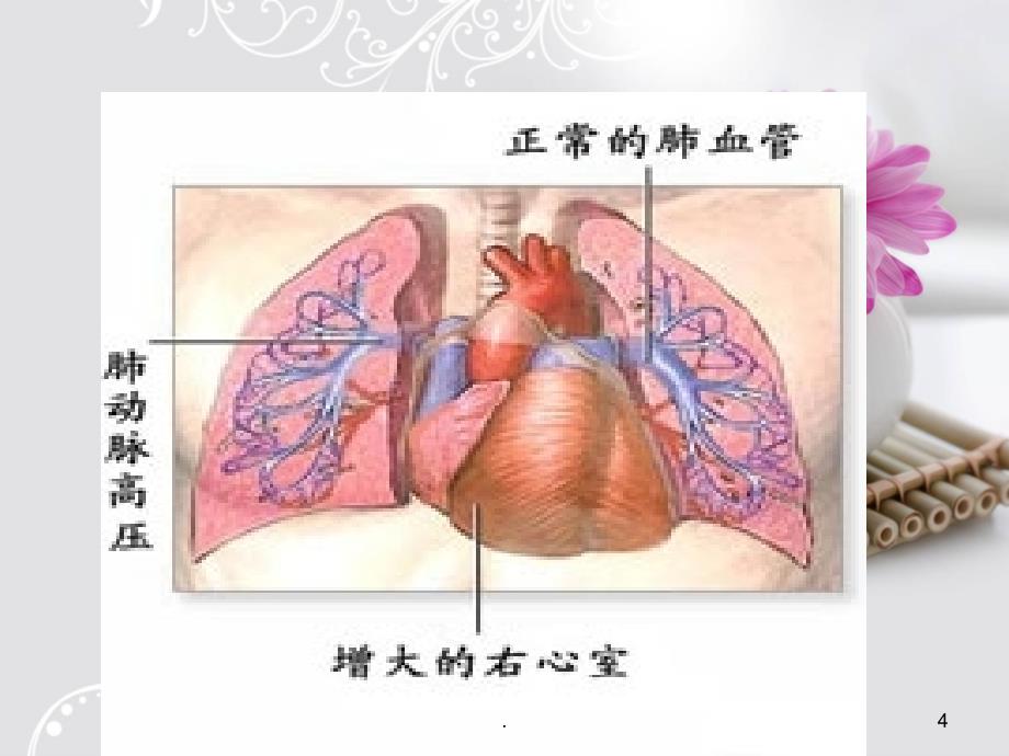 肺动脉高压护理查房PPT课件_第4页