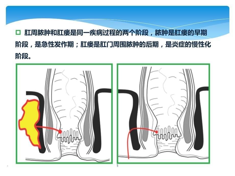 肛瘘的MRI诊断PPT课件_第5页