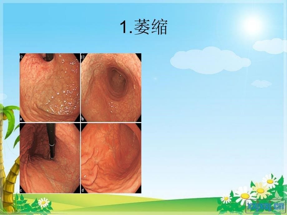 京都胃炎分类_第5页