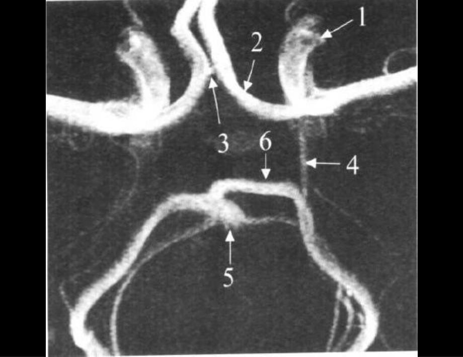 前交通动脉瘤解剖与临床参考PPT_第5页