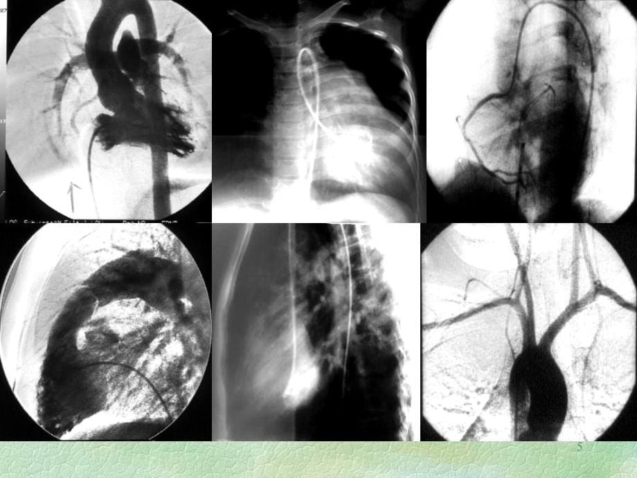 心脏与大血管X线诊断参考PPT_第5页