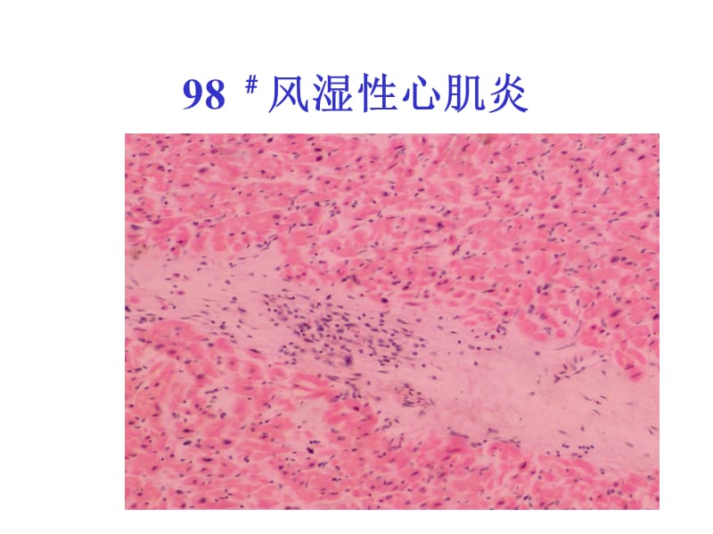 病理学1心血管系统疾病参考课件_第3页