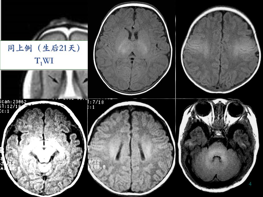 生儿缺氧缺血或窒息所致脑损伤的影像学诊断_第4页