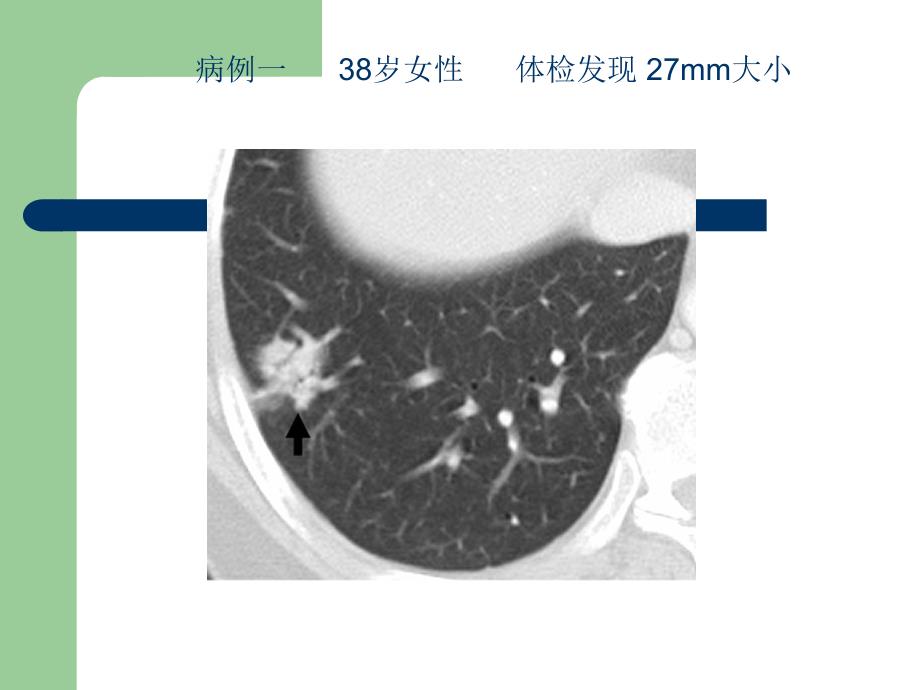 肺磨玻璃阴影影像诊断及临床处理原则_第2页