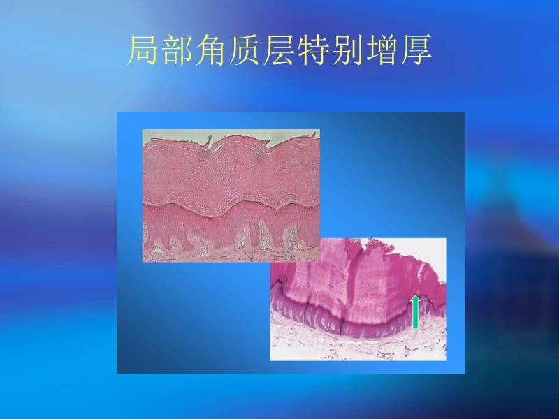 皮肤组织病理的基本变化84498_第5页