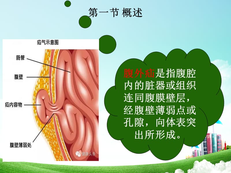 腹外疝病人的护理15422_第4页