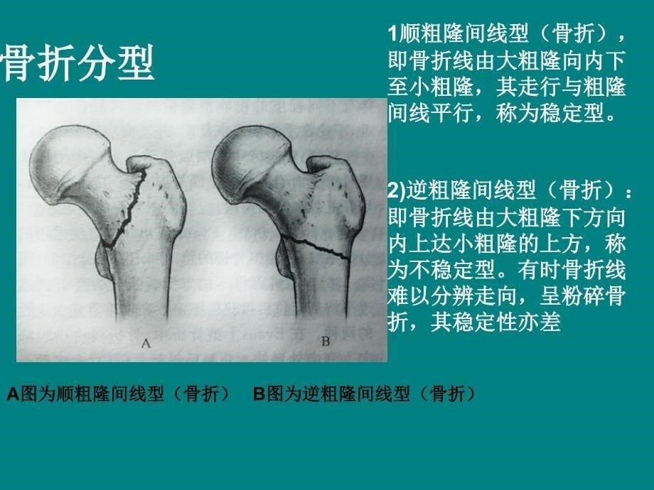 股骨粗隆间骨折36468_第5页