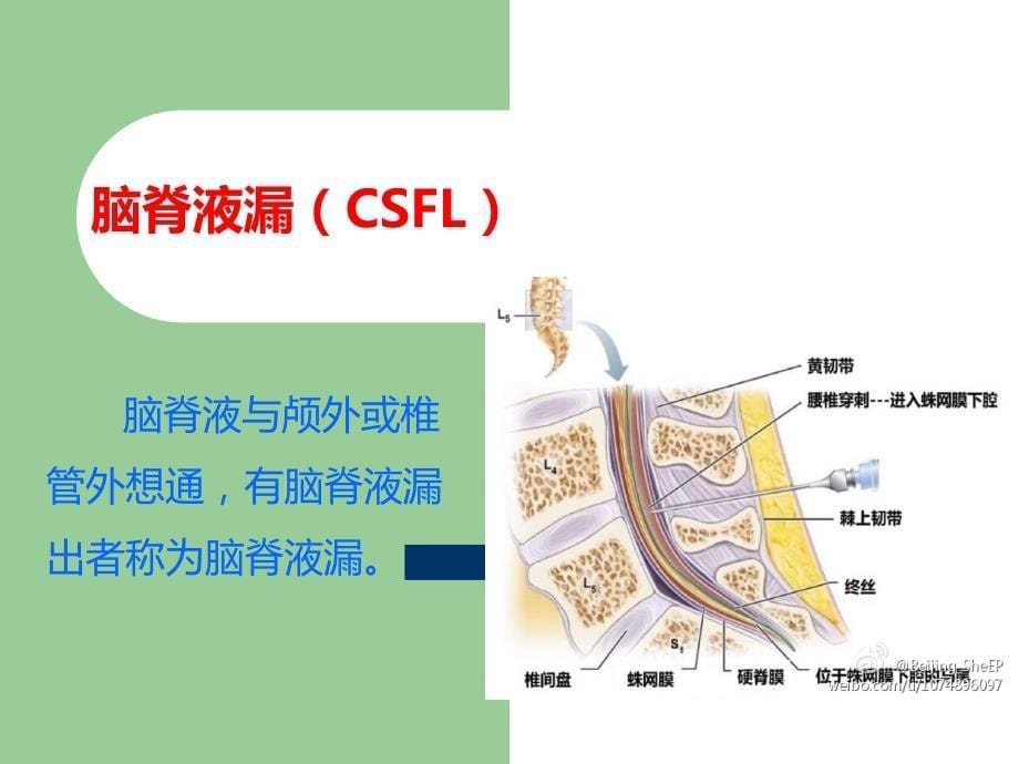 腰椎术后脑脊液漏护理PPT课件123_第5页