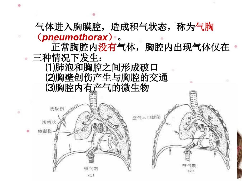 胸腔闭式引流术课件PPT课件123_第4页