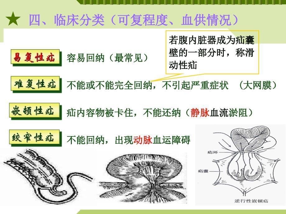 腹外疝病人的护PPT课件_第5页