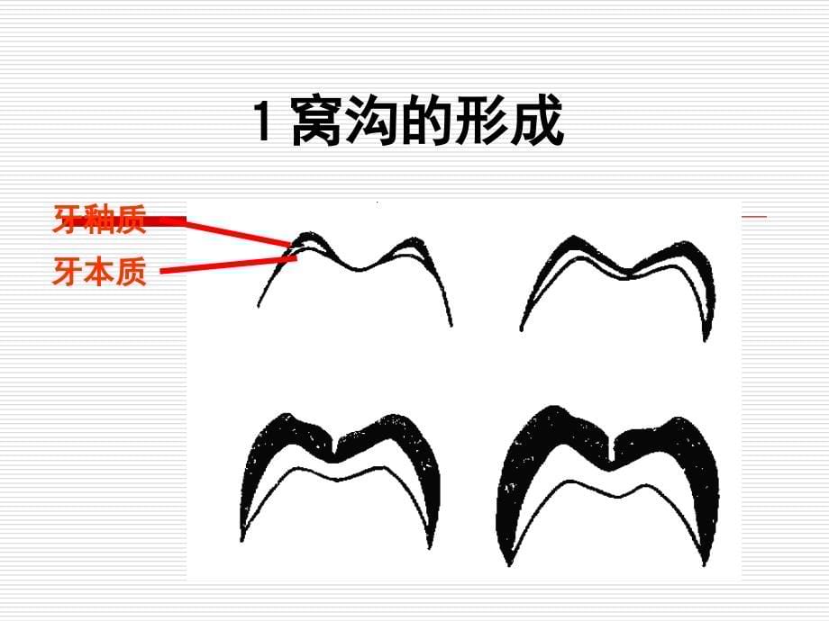 窝沟封闭预防性充填和ARTPPT课件_第5页