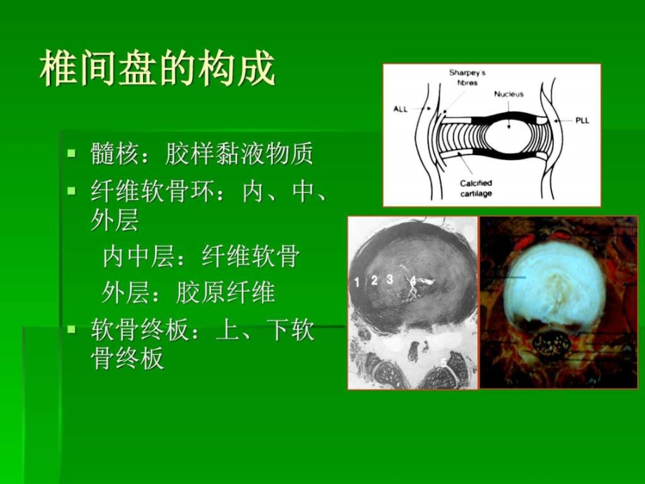 椎间盘突出的影像学诊断共79页PPT课件_第4页