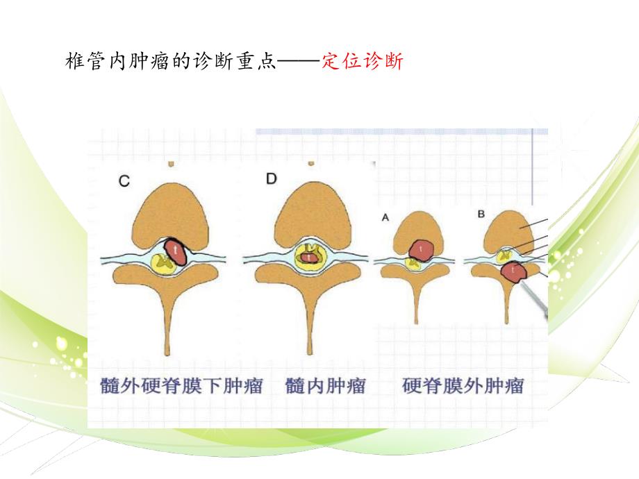 椎管内常见肿瘤的MRI诊断PPT课件_第4页