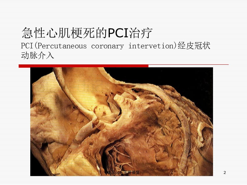 急性心肌梗死的PCI治疗[汇报]_第2页