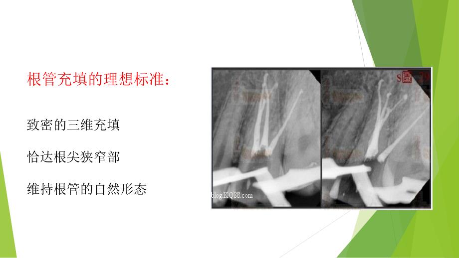 根管治疗术(五)：根管充填PPT课件3_第3页