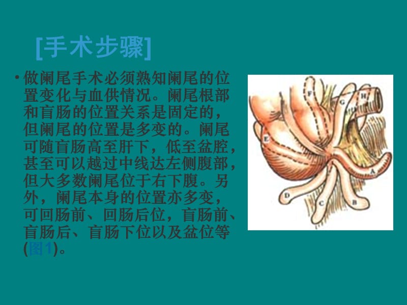 阑尾切除术图解PPT课件012_第4页