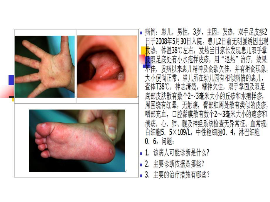 《手足口病》PPT课件_第1页