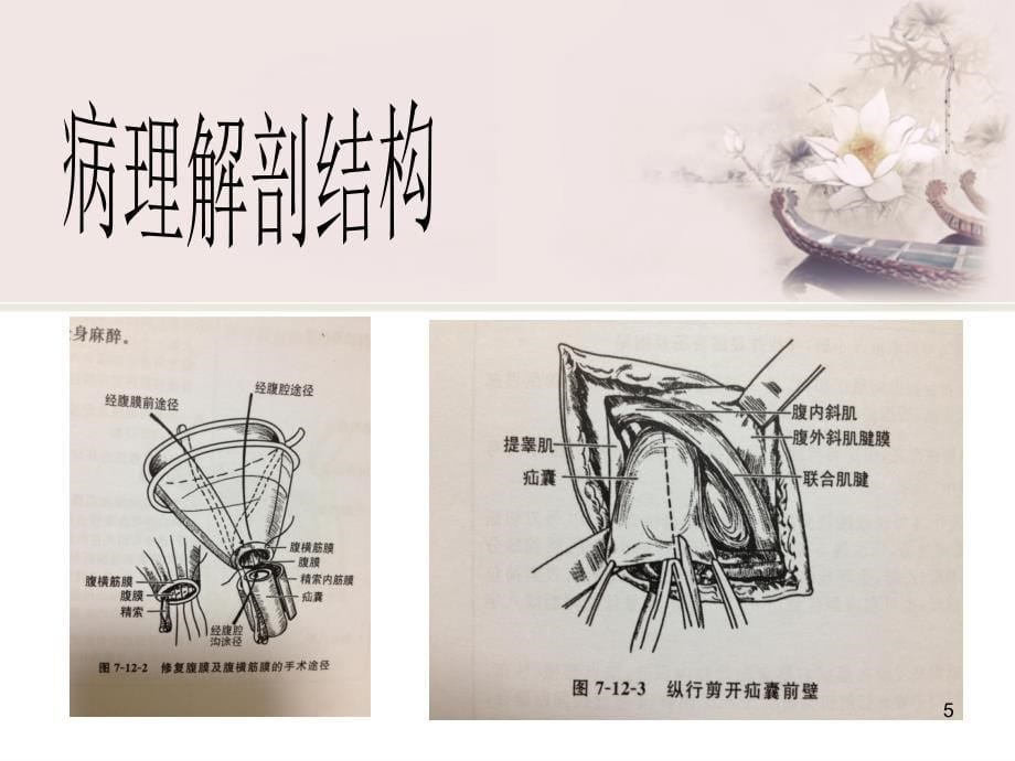 《腹股沟斜疝修补术》幻灯片课件_第5页