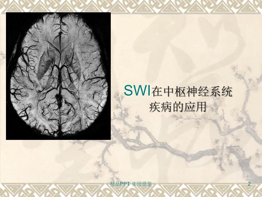 SWI在中枢神经系统应用[参考]_第2页