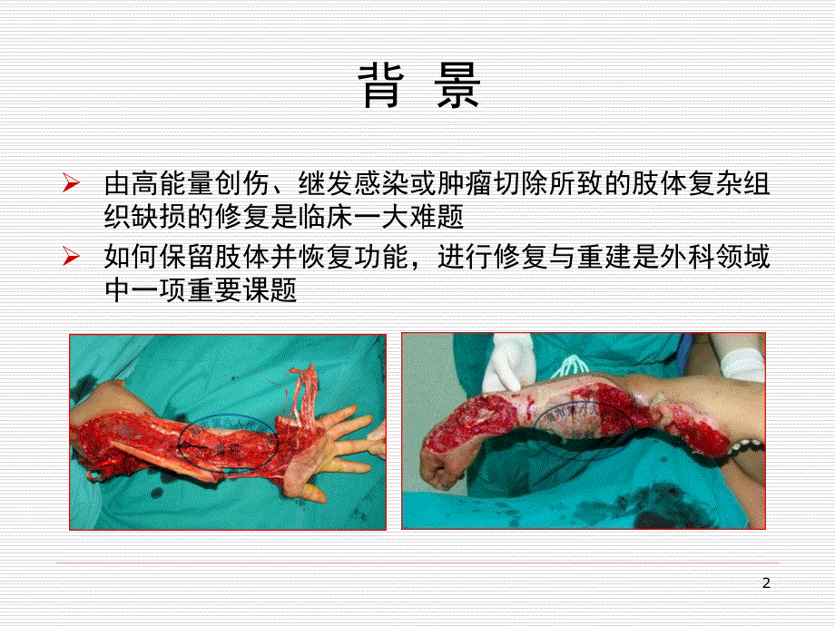 腓动脉嵌合骨皮瓣的设计与应用_第2页