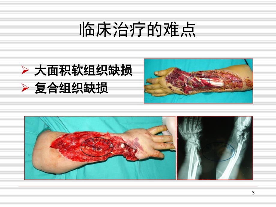 腓动脉嵌合骨皮瓣的设计与应用_第3页