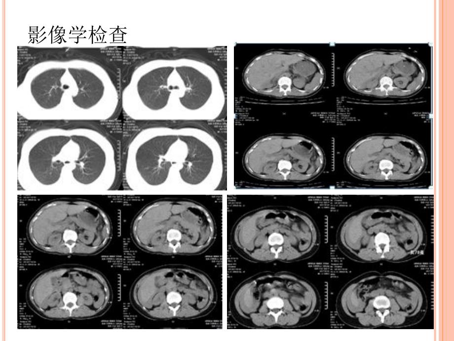 一例严重多发伤大出血病例分享_第3页