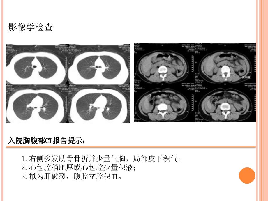 一例严重多发伤大出血病例分享_第4页