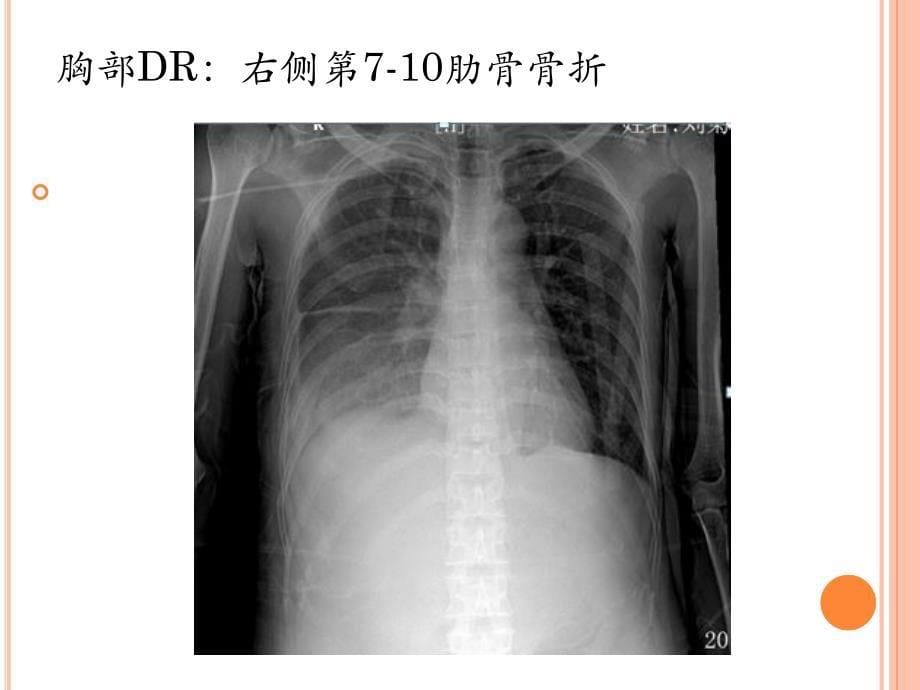 一例严重多发伤大出血病例分享_第5页