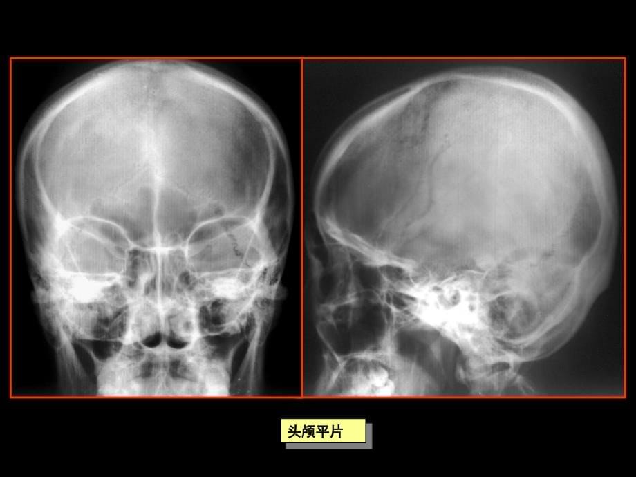 中枢神经系统检查方法及正常表现_第5页