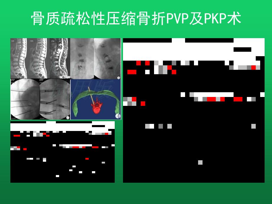 腰间盘突出的介入微创治疗_第3页