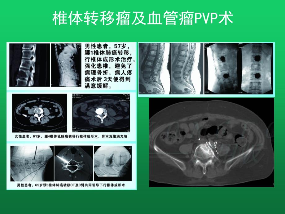 腰间盘突出的介入微创治疗_第4页