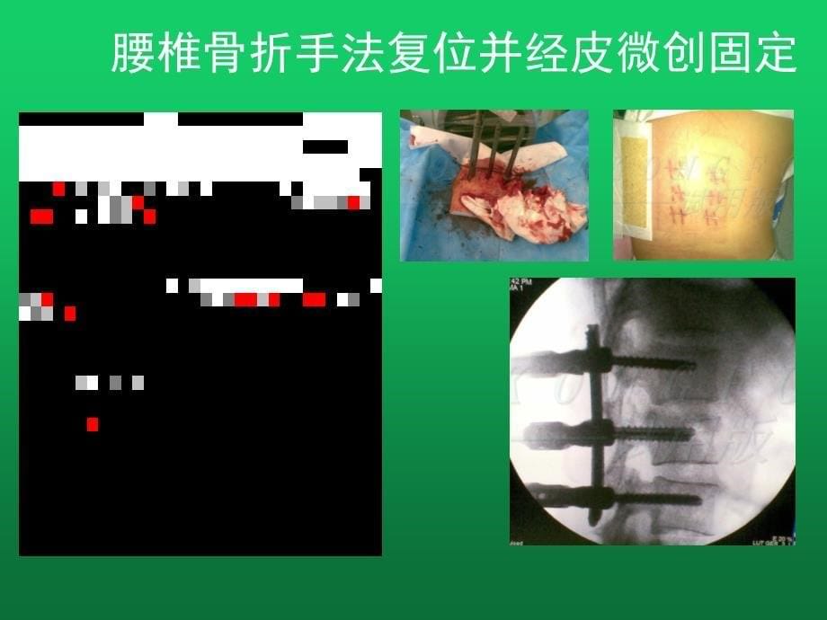 腰间盘突出的介入微创治疗_第5页