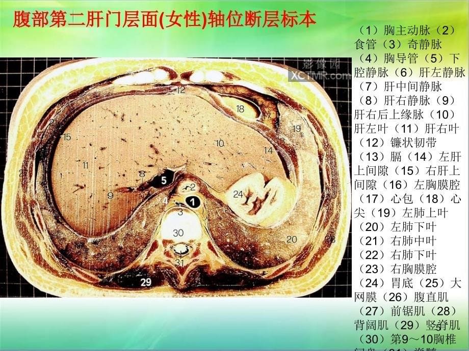 （优质医学）腹部断层解剖和断层CT(精品)_第5页
