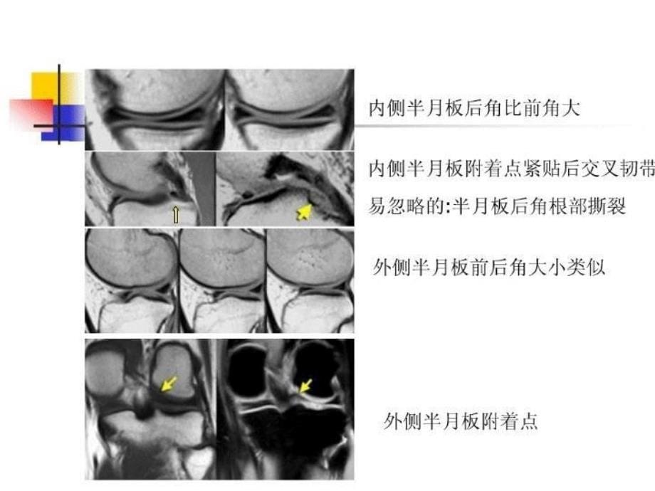 半月板 PPT课件_第5页