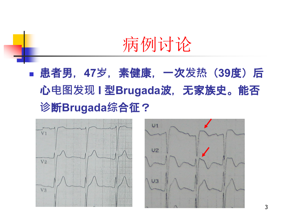 （优质医学）Brugada综合征的临床诊断_第3页