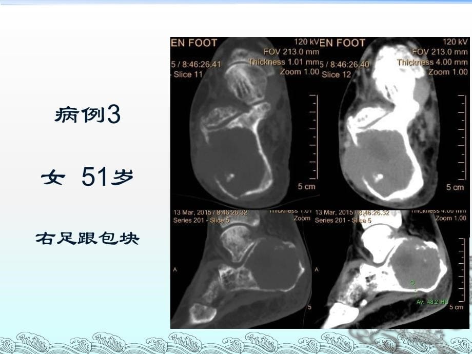 （优质医学）骨巨细胞瘤影像诊断_第5页