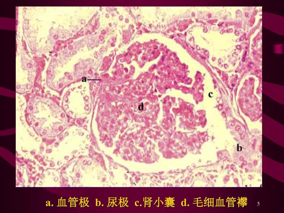 （优质医学）病理学-泌尿系统疾病_第5页