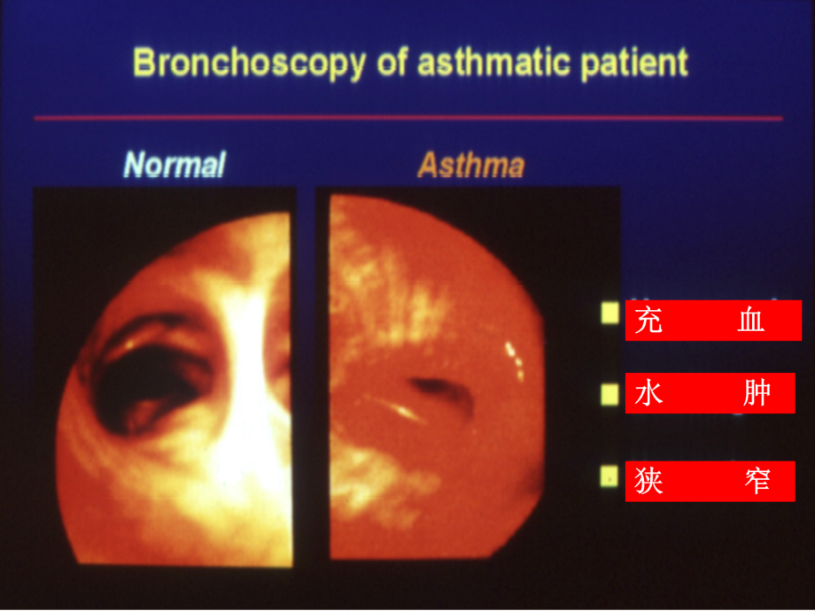 哮喘诊断及鉴别诊断课件PPT12_第3页